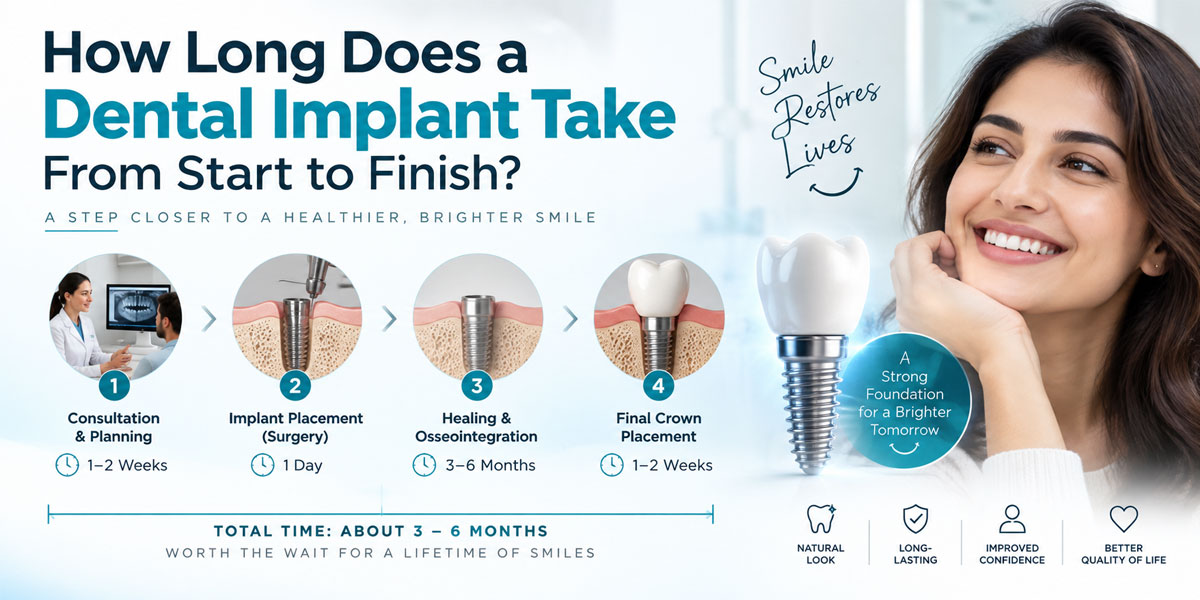 Dental implant treatment timeline from implant placement to final crown