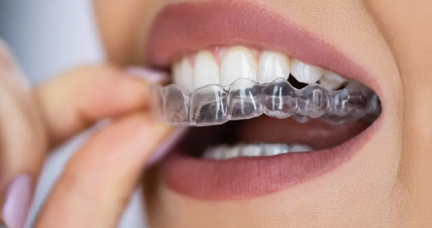 Invisalign Treatment in Paschim Vihar