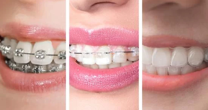 Invisalign Treatment in Paschim Vihar