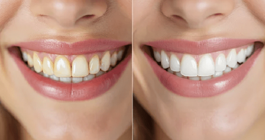 Invisalign Treatment in Paschim Vihar